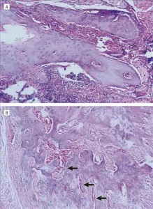 ESWT induces new bone formation